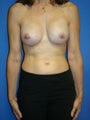 Breast Implant Revision Surgery