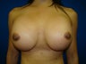 Breast Revision Surgery - Symmastia Repair