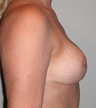 Breast rescue