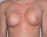 Bilateral Breast Augmentation