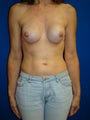 Breast Implant Revision Surgery