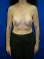 Extra Large Breast Augmentation Surgery with Saline Implants (Overfill)