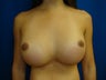 Breast Revision Surgery - Symmastia Repair