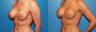 Implant exchange/capsulectomy/reposition of implant submuscular/circumarealar mastopexy