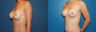 capsulectomy/repostion of implants submuscular