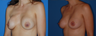 capsulectomy/repostion of implants submuscular/circumareolar mastopexy