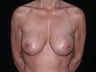 Revision Breast Augmentation