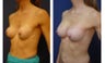 Breast implant correction