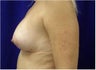 Breast Implants Revision, Breast lift