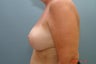 Implant Exchange with Capsulectomy and Full Mastopexy