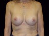 Breast Implant Replacement