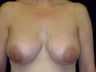 Breast Implant Removal, capsulectomy and replacement