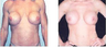 Breast Implant Revision