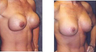 Breast Implant Revision