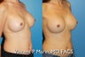 Breast Implant Revision