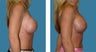 Breast Implant Revision