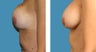 Breast Implant Revision