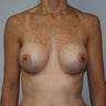Revision Breast Augmentation