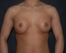 breast implant revision