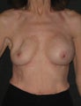 Removal & Replacement of Breast Implants