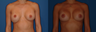 Breast Revision/Capsulorrhaphy