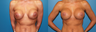 Implant exchange/capsulectomy/reposition of implant submuscular/circumarealar mastopexy