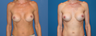 symmastia repair with acellular dermal matrix