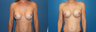 capsulectomy/repostion of implants submuscular