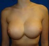 Revision Breast Surgery