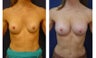 Breast implant correction