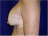 Breast Implants Revision, Breast lift