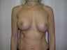 Implant malposition