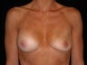 Breast implant revision