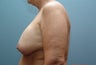 Implant Exchange with Capsulectomy and Full Mastopexy