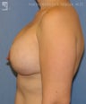 Breast Implant Removal & Replacement with a Mastopexy (breast lift)