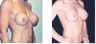 Breast Implant Revision