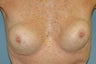 Breast Implant Revision