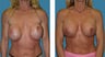 Breast Implant Revision
