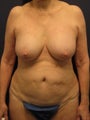 breast implant revision for capsular contracture