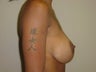 30 year old wanting larger implants - side view
