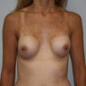 Revision Breast Augmentation
