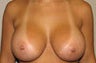 Breast Augmentation