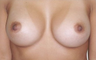 Breast Augmentation