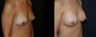 Breast Augmentation
