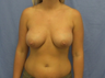 Breast Implants