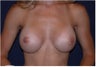 Breast Implants