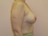Breast Augmentation  with lift