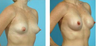 Breast Augmentation