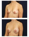 Breast Augmentation