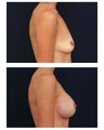 Breast Augmentation